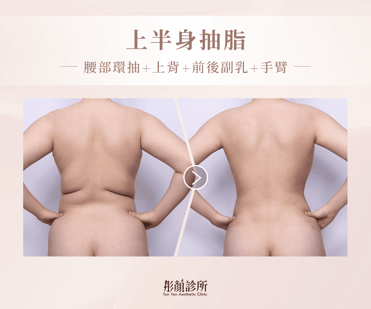 上半身抽脂案例術前術後對比照：腰部環抽、上背、前後副乳與手臂